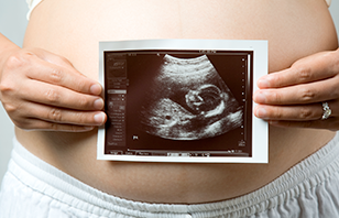 Hidronefrosis Prenatal