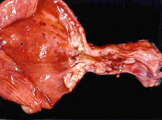 Cancer de uretra