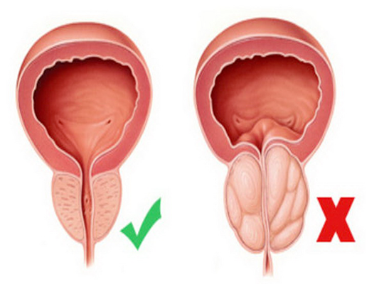 Reseccion de la prostata